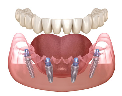 GD Dentistry | Implant Dentistry, Teeth Whitening and Ceramic Crowns