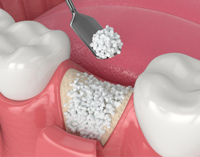 Bone Graft in Upper Manhattan